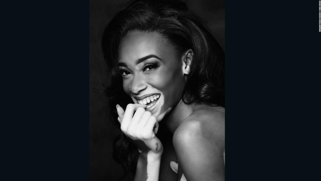 Winnie Harlow’s changing the face of fashion