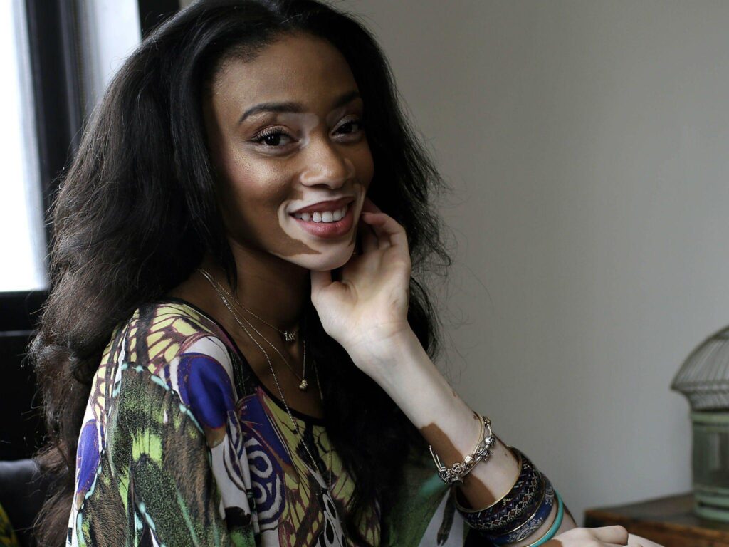 Winnie Harlow Everything you need to know about the star of
